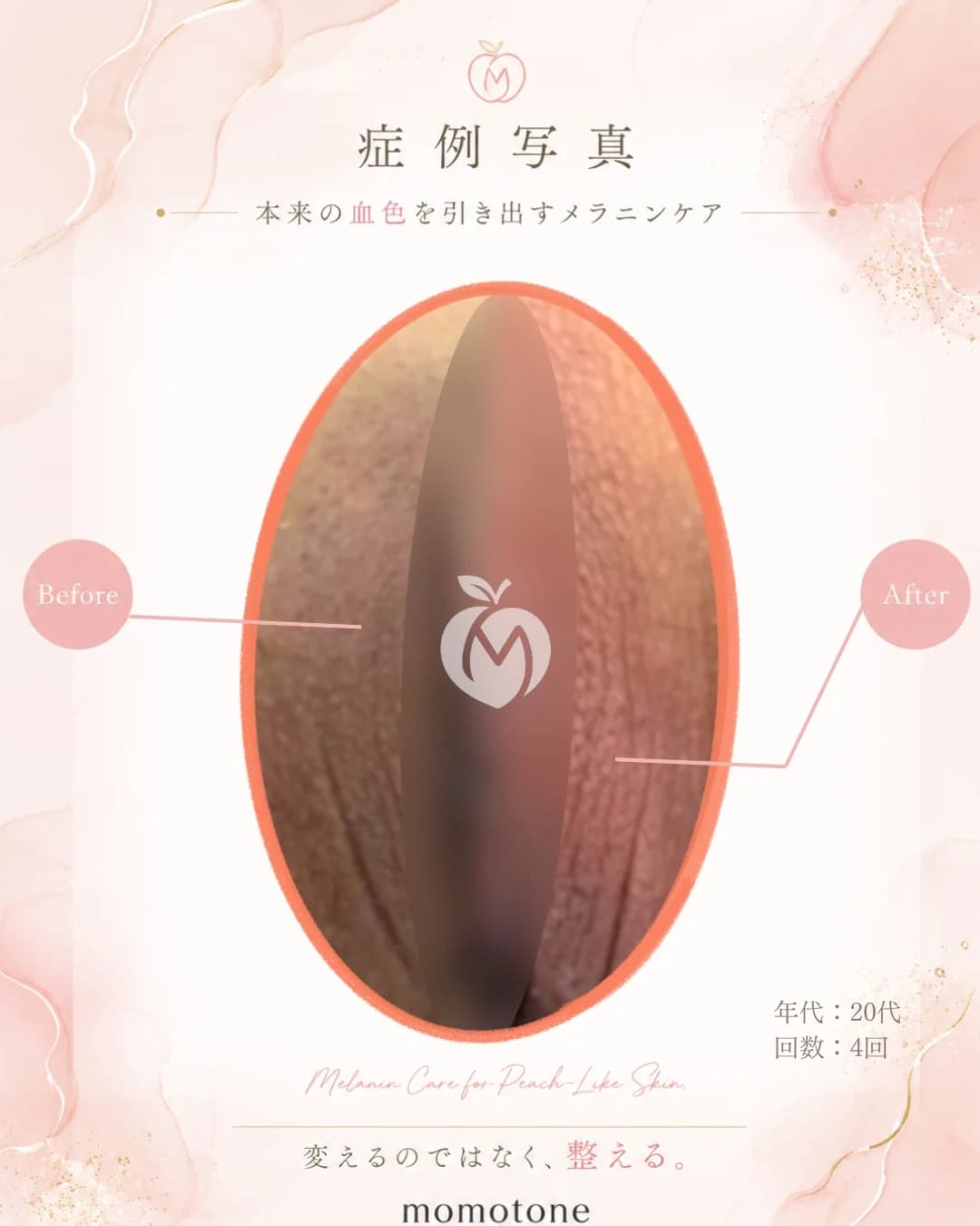 VIO 20代女性 4回施術後