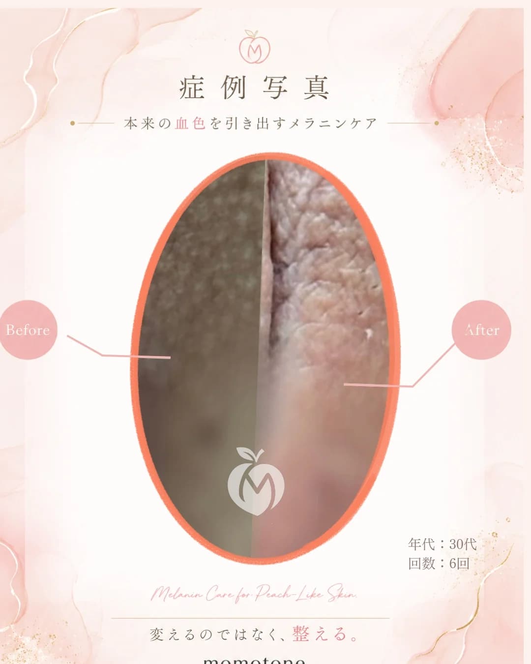 VIO 30代女性 6回施術後
