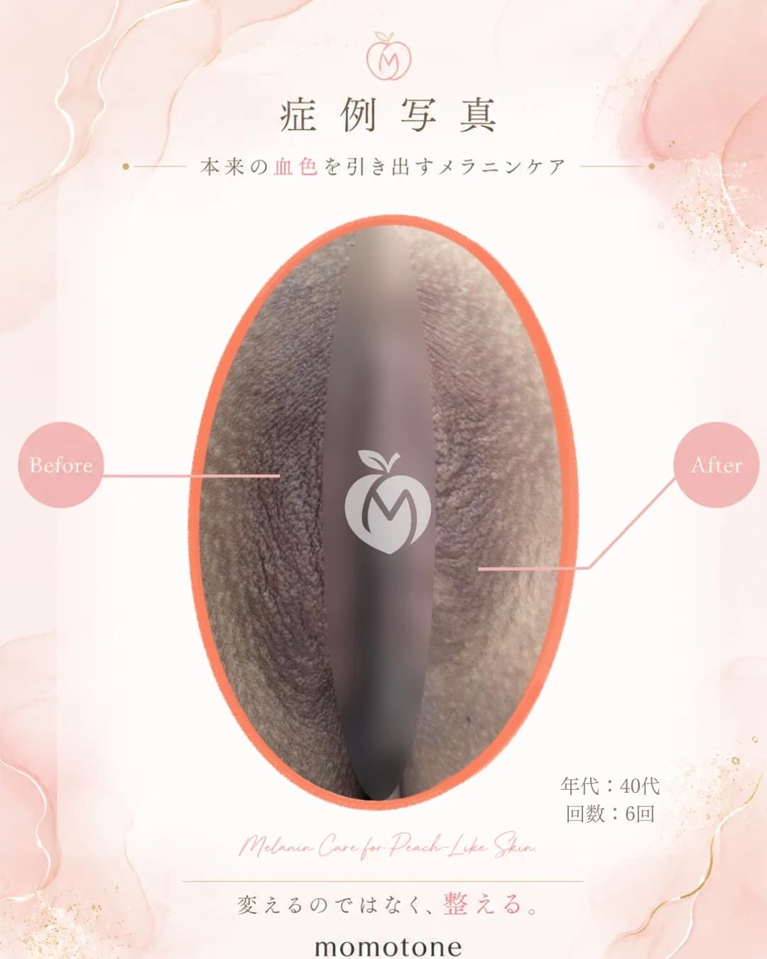 VIO 40代女性 6回施術後
